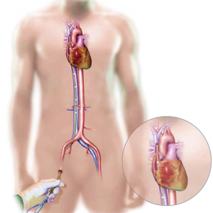 Bio-medicus multi-stage